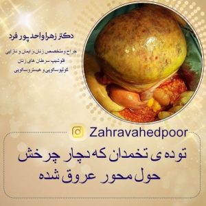 توده تخمدان