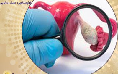 تنبلی تخمدان یا سندرم تخمدان پلی کیستیک و علائم آن