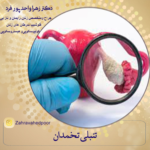 علائم تنبلی تخمدان