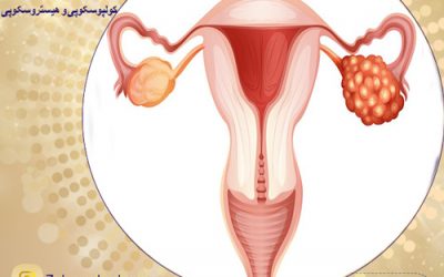 سرطان تخمدان چیست و چه علائمی دارد؟