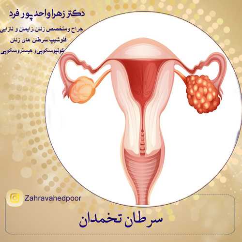 سرطان تخمدان