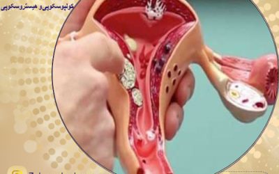 علت به وجود آمدن فیبروم رحم