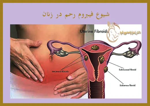 فیبروم رحم ، بیماری شایع زنان