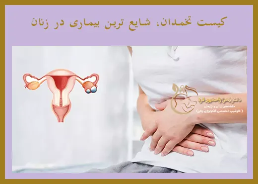 کیست تخمدان بیماری شایع در بانوان