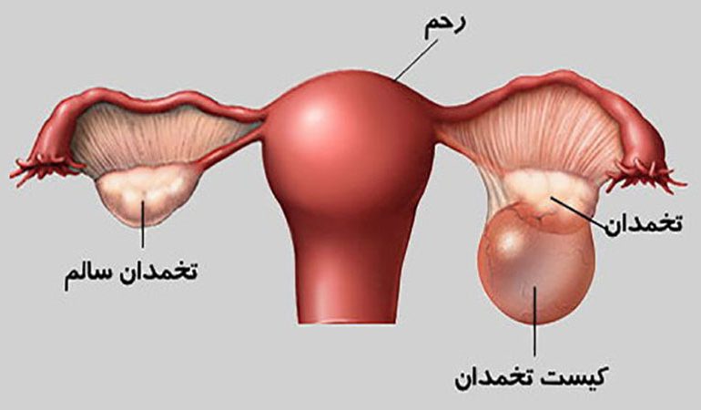 کیست رحم