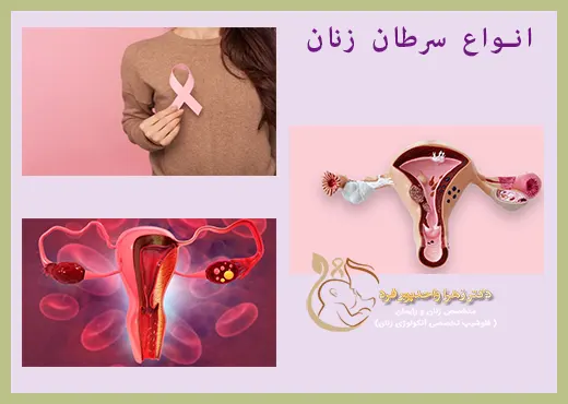 انواع سرطان زنان
