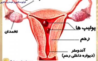 پولیپ رحم و درمان آن