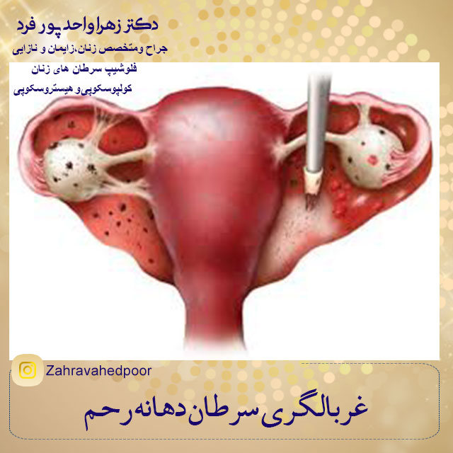 آندومتریوز
