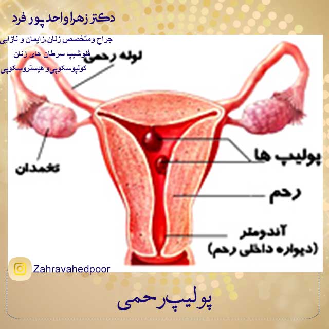 پولیپ-رحم