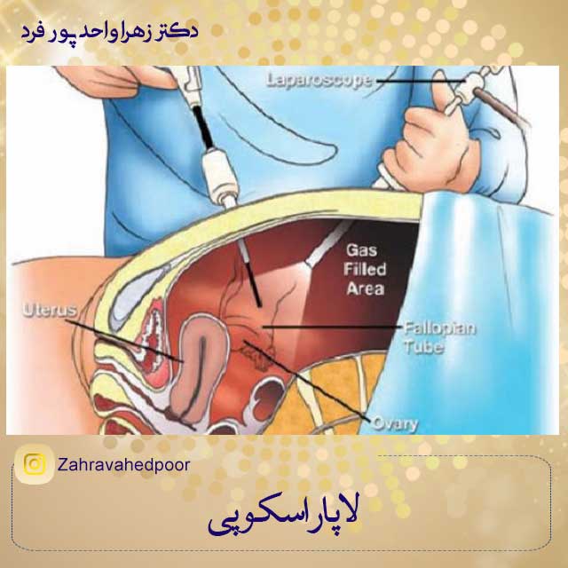 لاپاراسکوپی