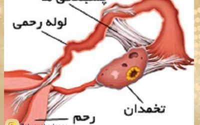 چسبندگی رحم، علل و راه درمان