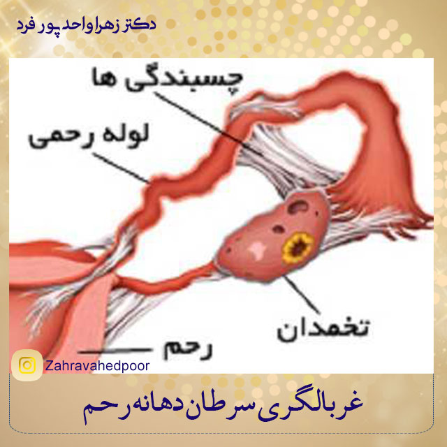 چسبندگی-رحم