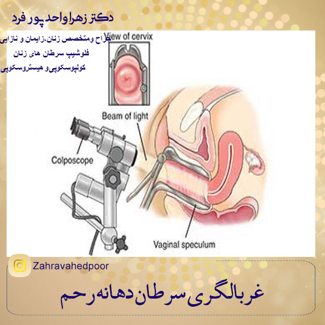 کولپوسکوپی