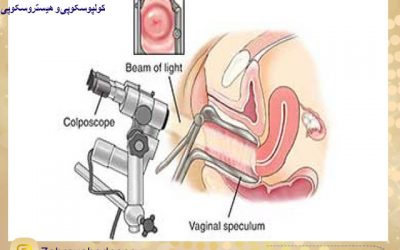 بررسی دهانه رحم با کولپوسکوپی
