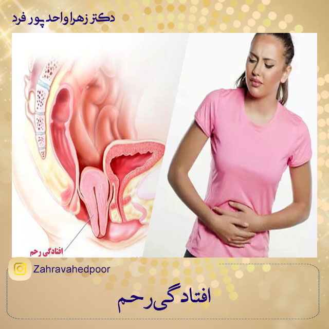 افتادگی-رحم