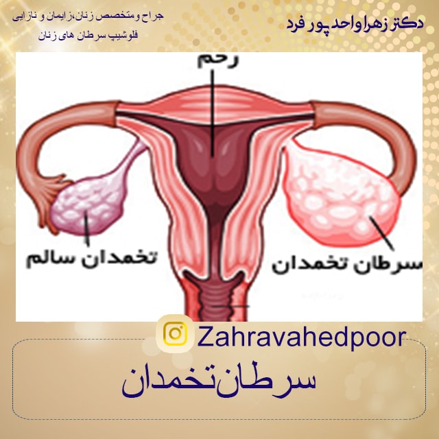 بهترین دکتر برای درمان سرطان تخمدان