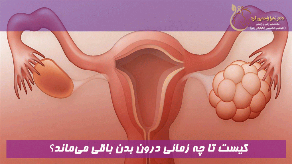 کیست تا چه زمانی درون بدن باقی میماند؟