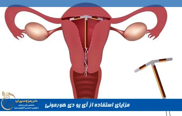 مزایای استفاده از آی یو دی هورمونی