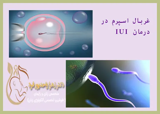 غربال اسپرم در درمان ناباروری IUI