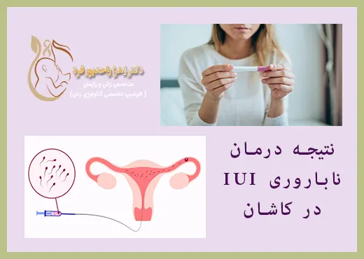 نتیجه درمان IUI