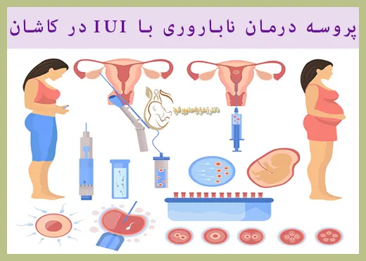 پروسه درمان با IUI