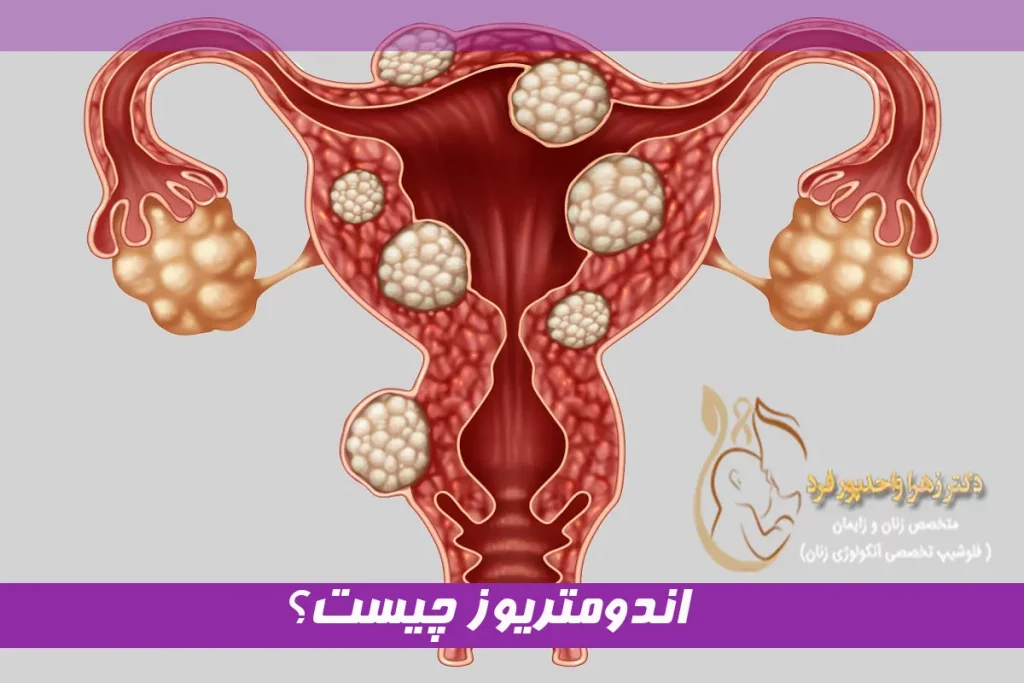 اندومتریوز چیست؟