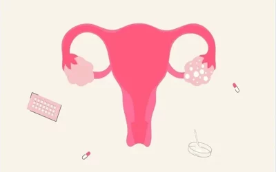 سندرم تخمدان پلی کیستیک (PCOS) و هر آنچه باید از آن بدانید