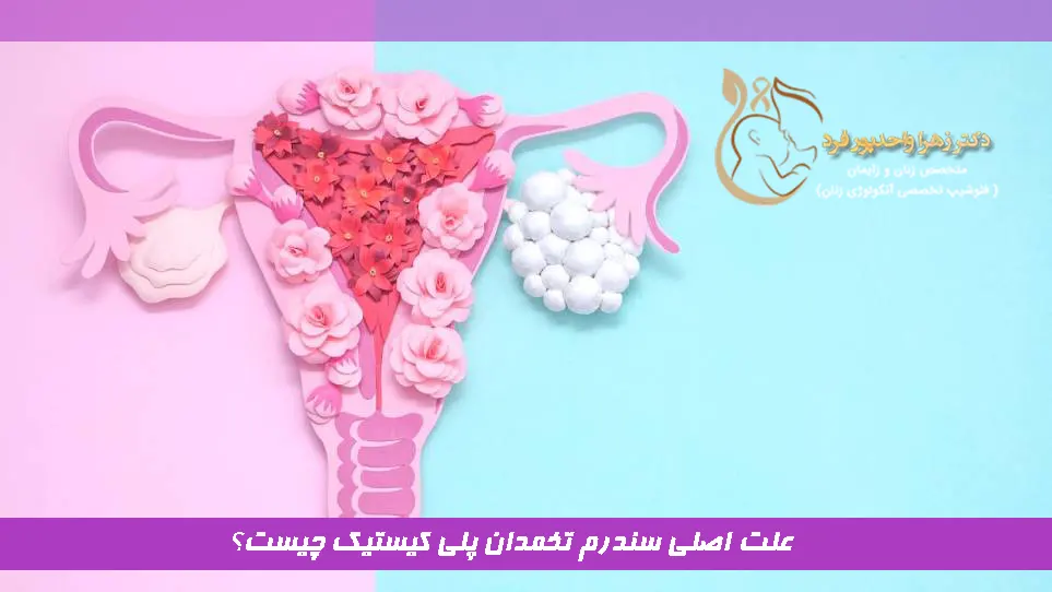 علت اصلی سندرم تخمدان پلی کیستیک چیست؟