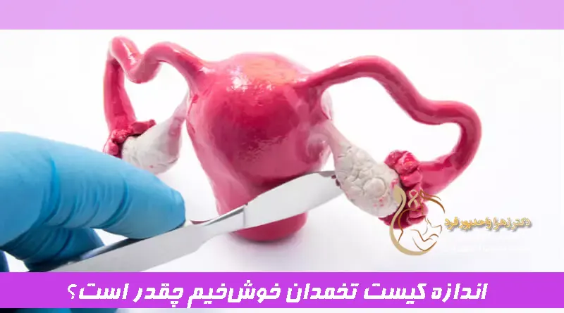 اندازه کیست تخمدان خوشخیم چقدر است؟