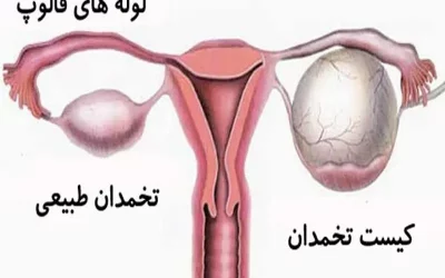 اندازه کیست تخمدان